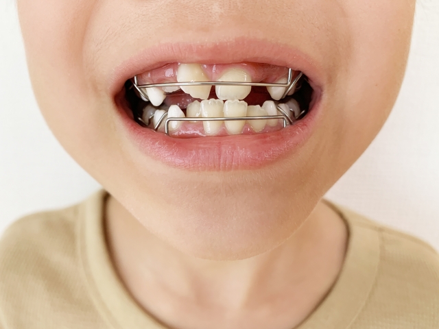 小児部分矯正（床矯正など）