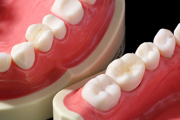 かぶせ物とは？