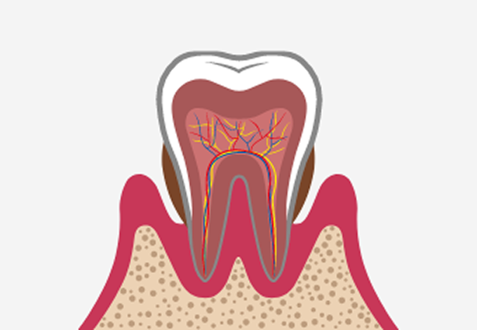 重度歯周病（進行期）